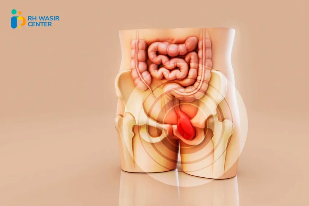 BAB Berdarah, Apakah Selalu Wasir